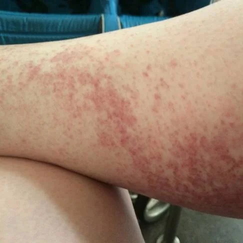 Heat rash on online legs